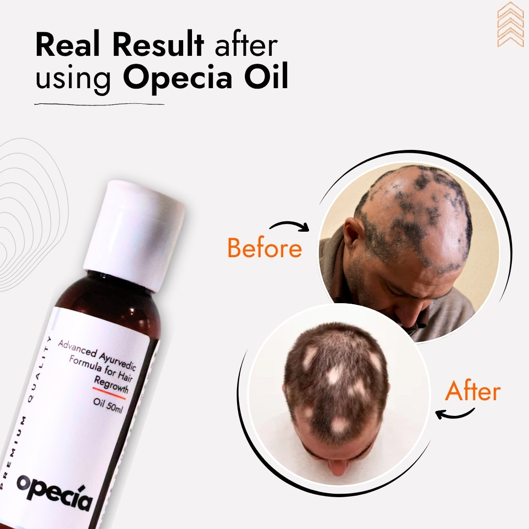 Alopecia Hair Patch Solution for Bald Patches - 100% Natural Treatment