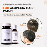 Alopecia Areata उपचार किट — गंजे पैच के लिए बेहतर प्राकृतिक समाधान (बालों की वृद्धि व खोपड़ी पोषण)