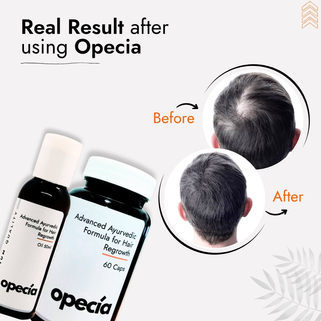 Trichotillomania Hair Loss Treatment | Best Natural Ayurvedic Solution for Trichotillomania Alopecia