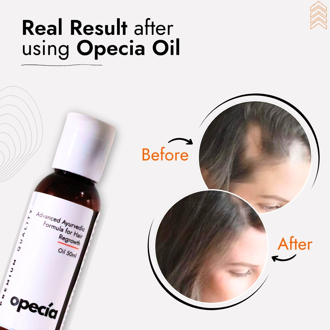 Alopecia Hair Patch Solution for Bald Patches - 100% Natural Treatment