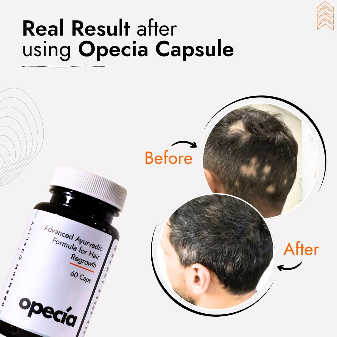 Alopecia Hair Patch Solution | Alopecia Areata Treatment Medicine | 100% Pure Extract with No Side Effects