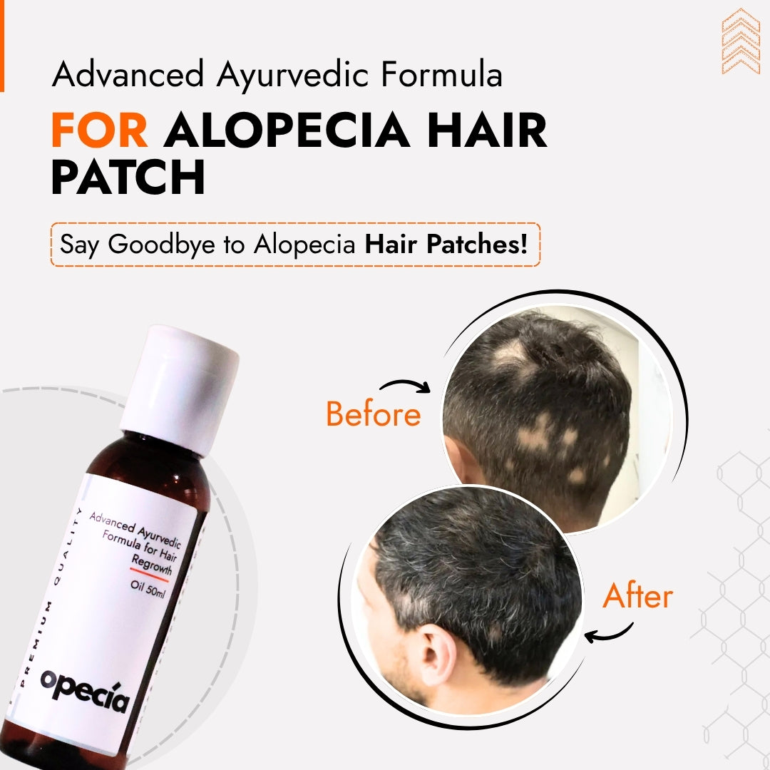 Alopecia Hair Patch Solution for Bald Patches - 100% Natural Treatment
