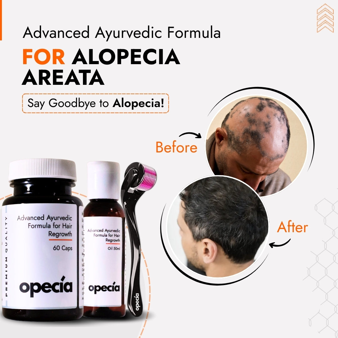 Alopecia Areata Treatment Medicine Kit – Best Natural Solution for Hair Patch, Hair Regrowth & Scalp Nourishment