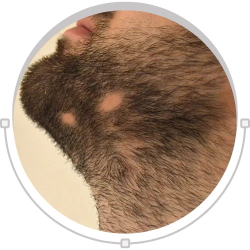 Alopecia Barbae