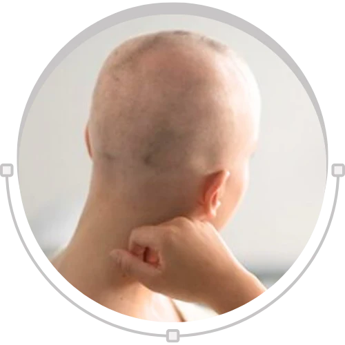 Chemotherapy Hair Loss
