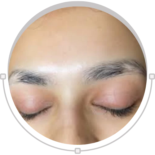 Eyebrow Patch Loss