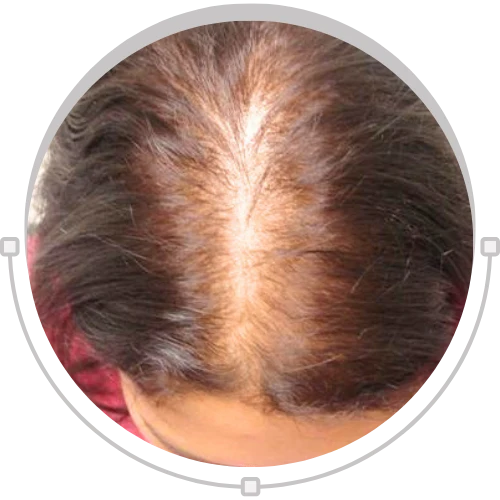 Female Hair Baldness