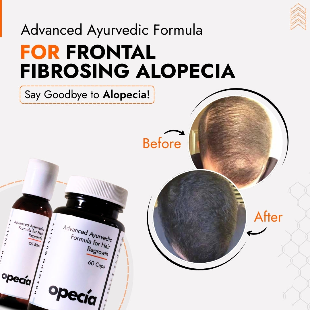 Frontal Fibrosing Alopecia Hair Loss Treatment | Best Natural Ayurvedic Solution for Frontal Fibrosing Alopecia