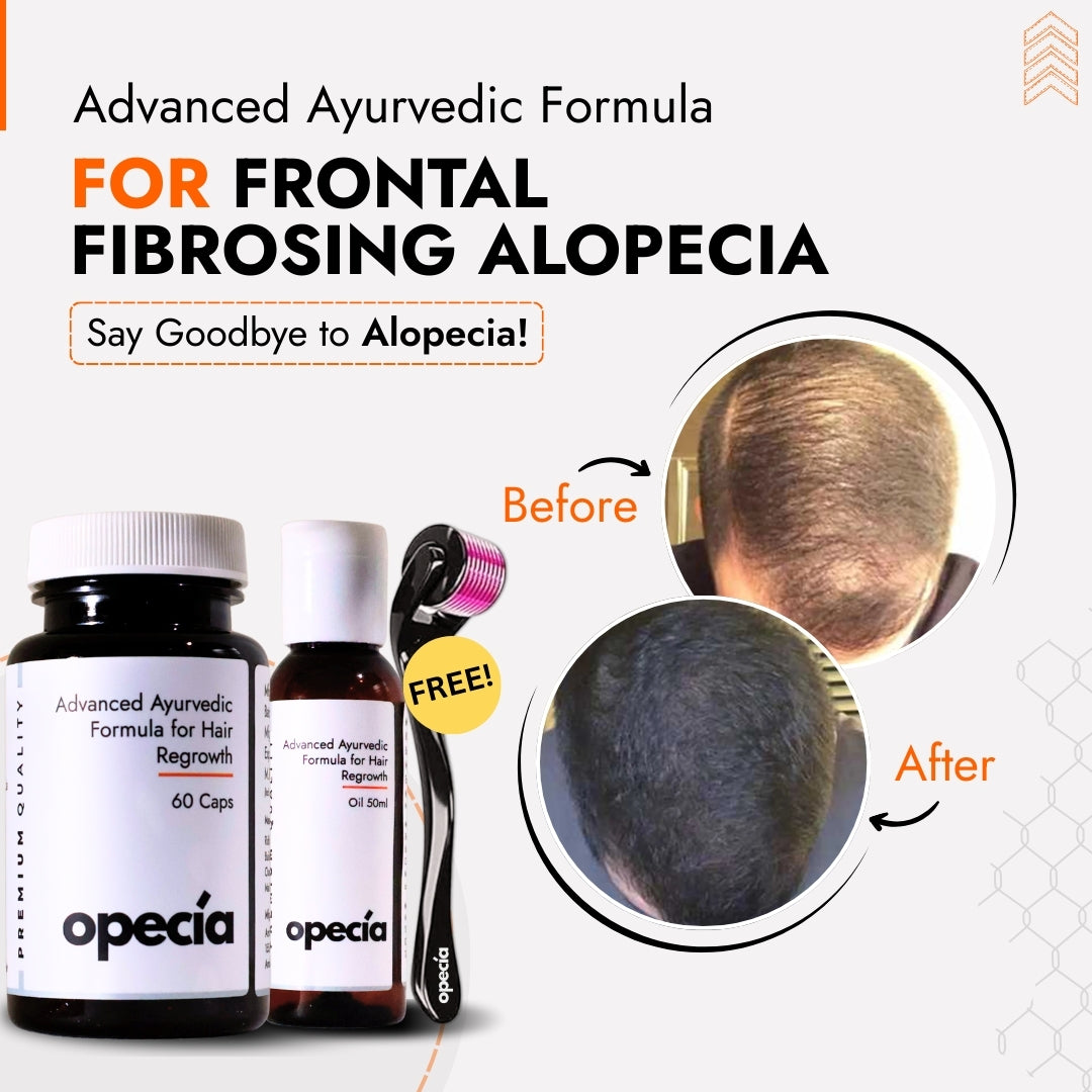 Frontal Fibrosing Alopecia Hair Loss Treatment | Best Natural Ayurvedic Solution for Frontal Fibrosing Alopecia