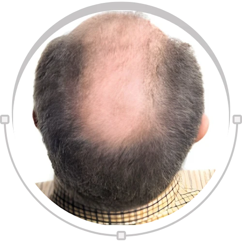 Male Hair Baldness