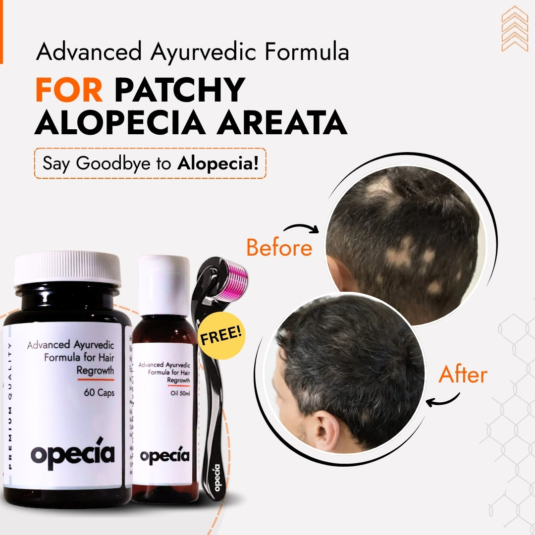 Best Ayurvedic Treatment for Patchy Alopecia Areata