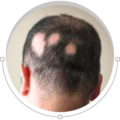 Scarring Alopecia