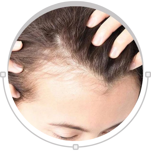 Traction Alopecia