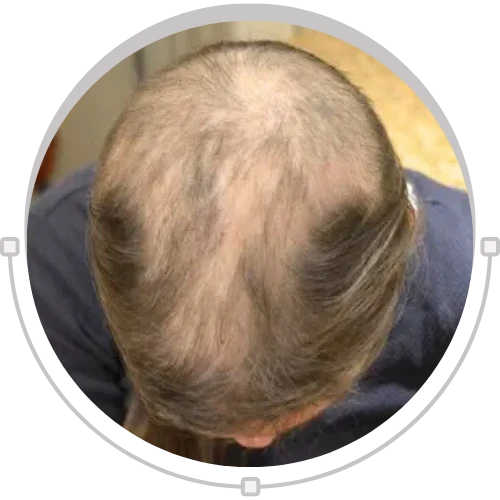 Trichotillomania