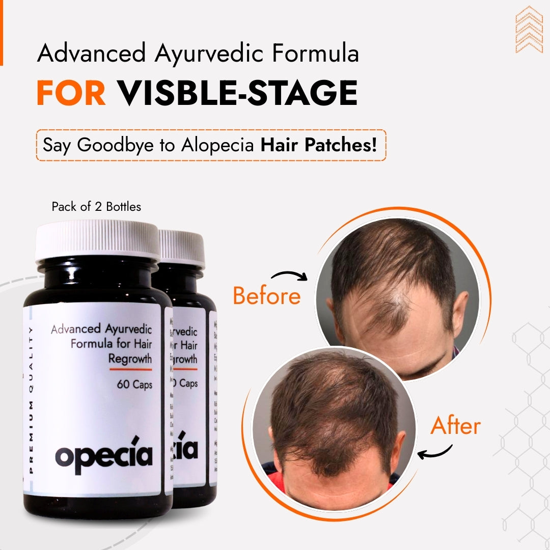 Alopecia Hair Patch Solution | Alopecia Areata Treatment Medicine | 100% Pure Extract with No Side Effects
