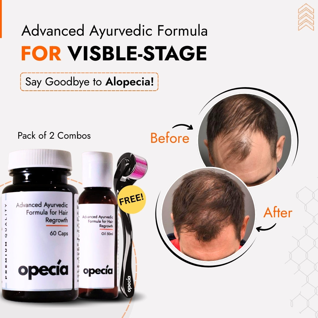 Alopecia Areata Treatment Medicine Kit – Best Natural Solution for Hair Patch, Hair Regrowth & Scalp Nourishment