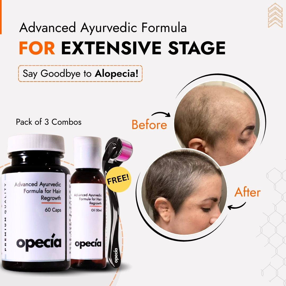 Alopecia Areata Treatment Medicine Kit – Best Natural Solution for Hair Patch, Hair Regrowth & Scalp Nourishment