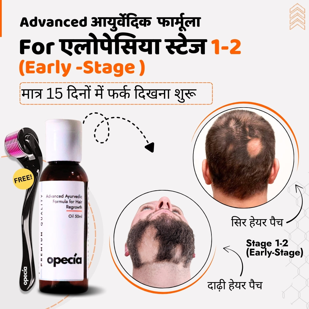एलोपेसिया का आयुर्वेदिक इलाज - प्राकृतिक रूप से बालों को पुनः उगाएँ