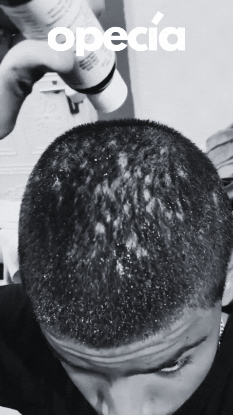 Opecia hair treatment result